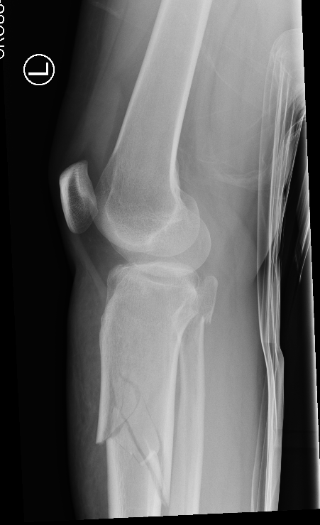 Proximal Tibial Fracture 2